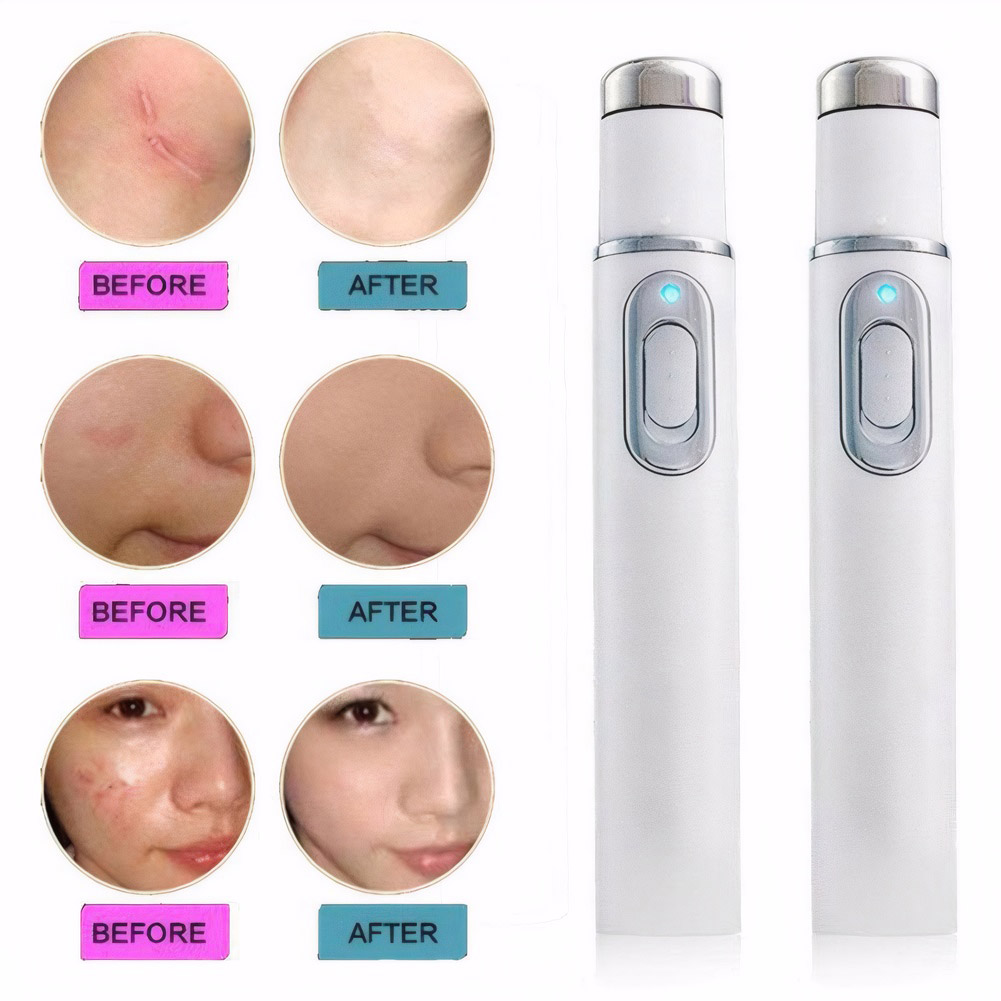 Mavi Işık Terapisi Akne Kalem  - Acne Light Therapy Pen incelemesi ve fiyatı
