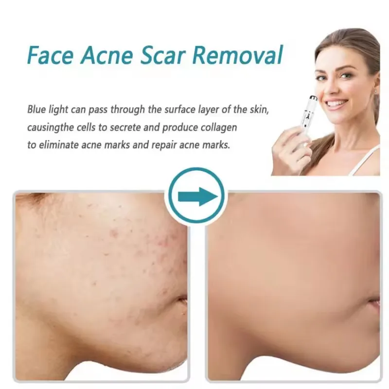Mavi Işık Terapisi Akne Kalemi - Acne Light Therapy Pen incelemesi ve fiyatı